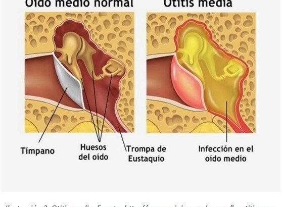 Descubre las enfermedades del oído más comunes, como la otitis media, otitis externa, acúfenos y enfermedad de Meniere. Analizaremos sus causas, síntomas y tratamientos.
