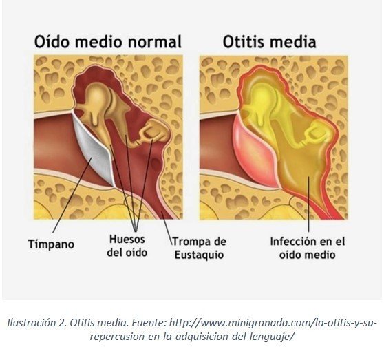 Descubre las enfermedades del oído más comunes, como la otitis media, otitis externa, acúfenos y enfermedad de Meniere. Analizaremos sus causas, síntomas y tratamientos.