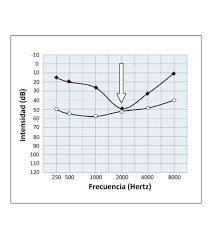 Otosclerosis Audiometría: Diagnóstico y Tratamiento de la Enfermedad del Oído