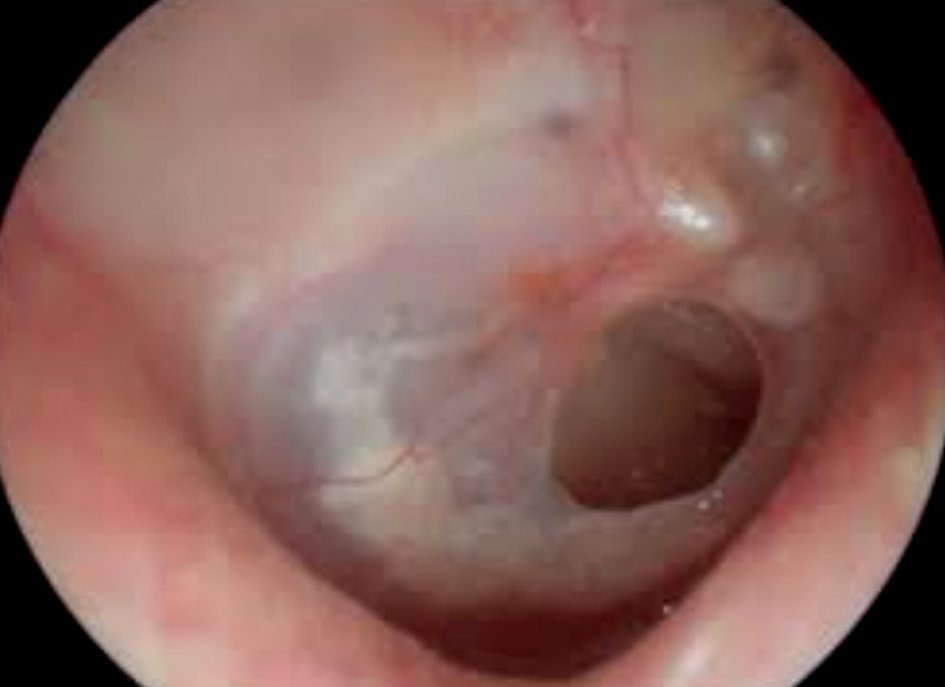 Otitis_orlgroupec